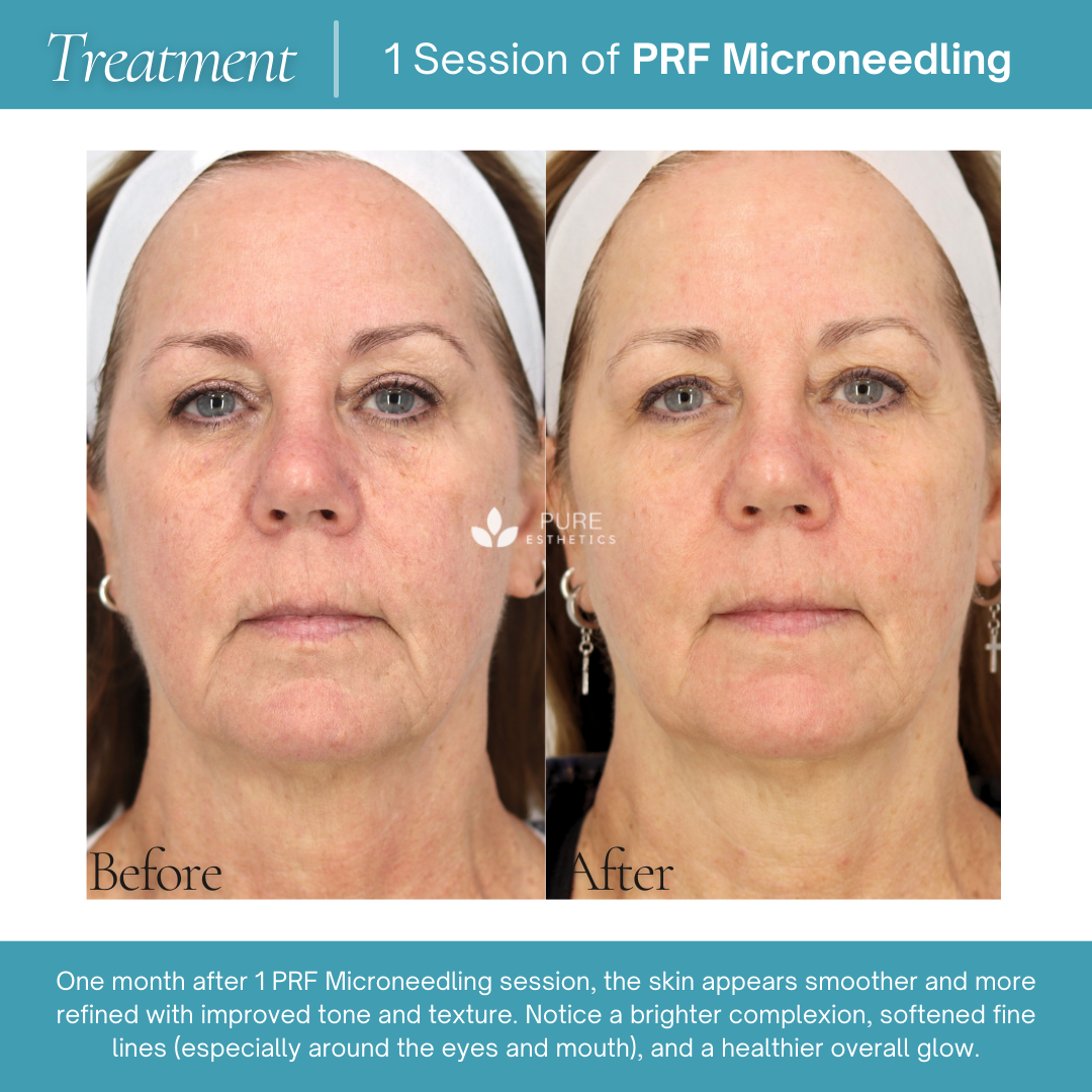 PRF Microneedling Before & After