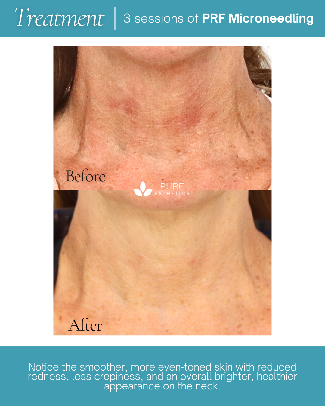 PRF Microneedling Before & After