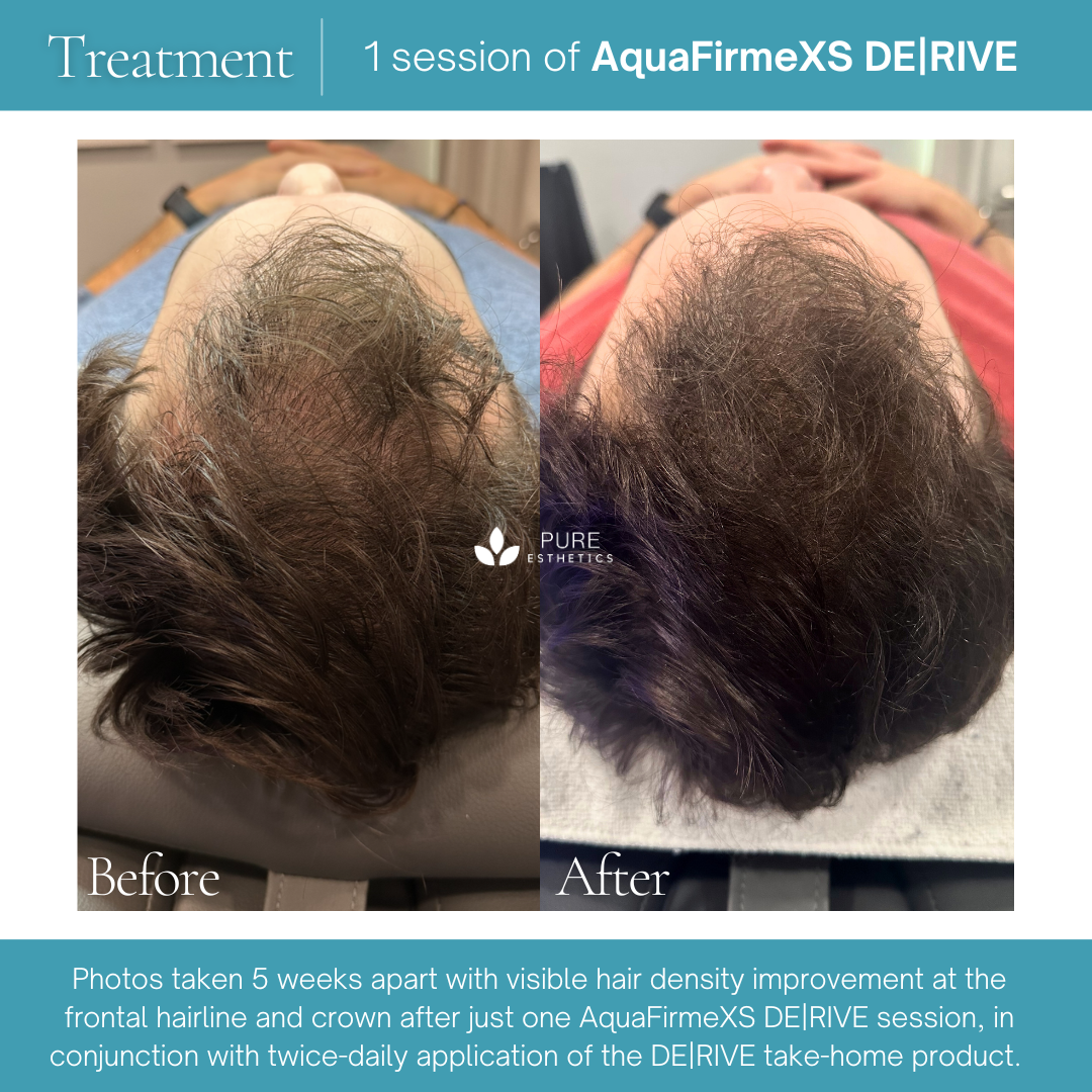 Aquafirme DERIVE Before & After