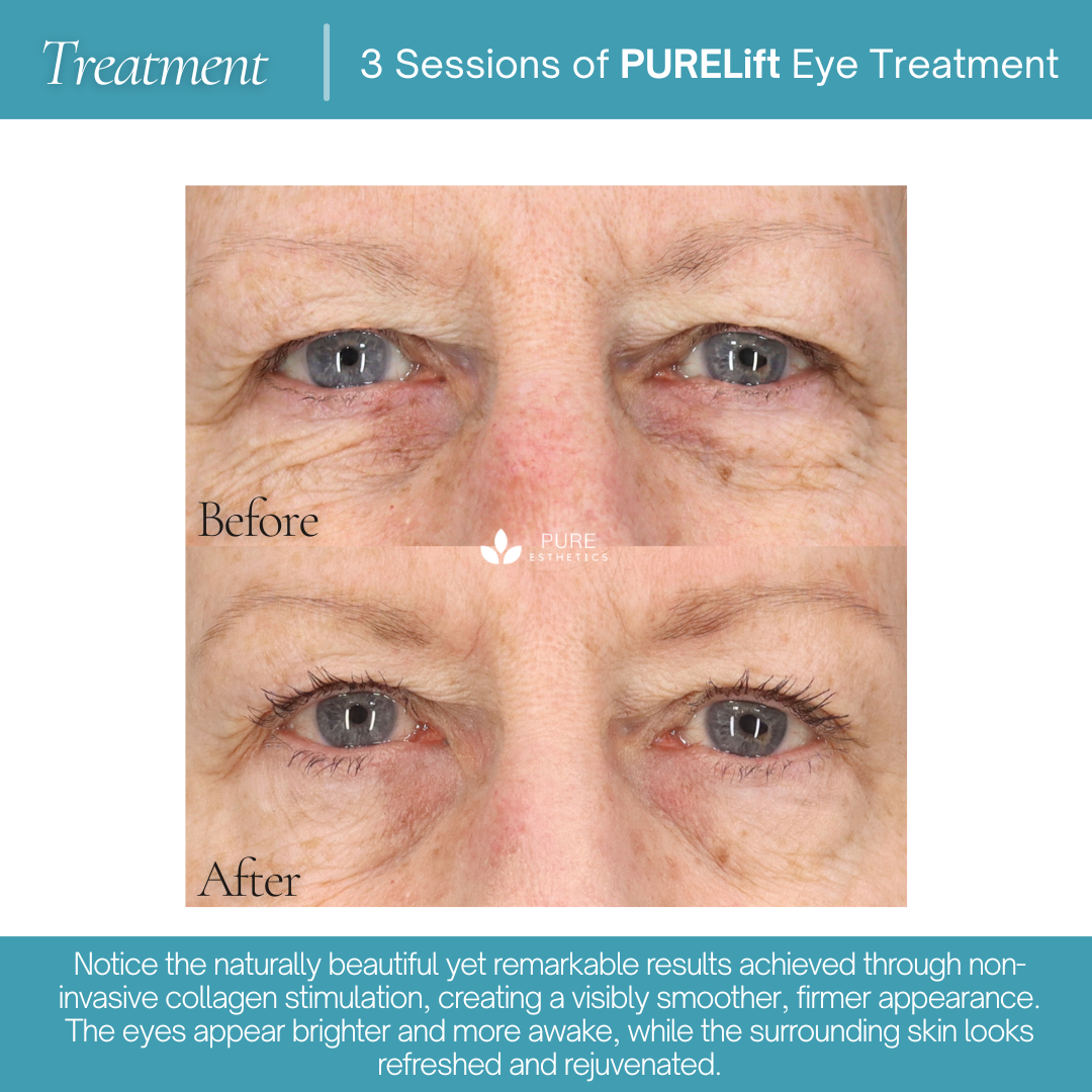 PURELift Eyes Before & After
