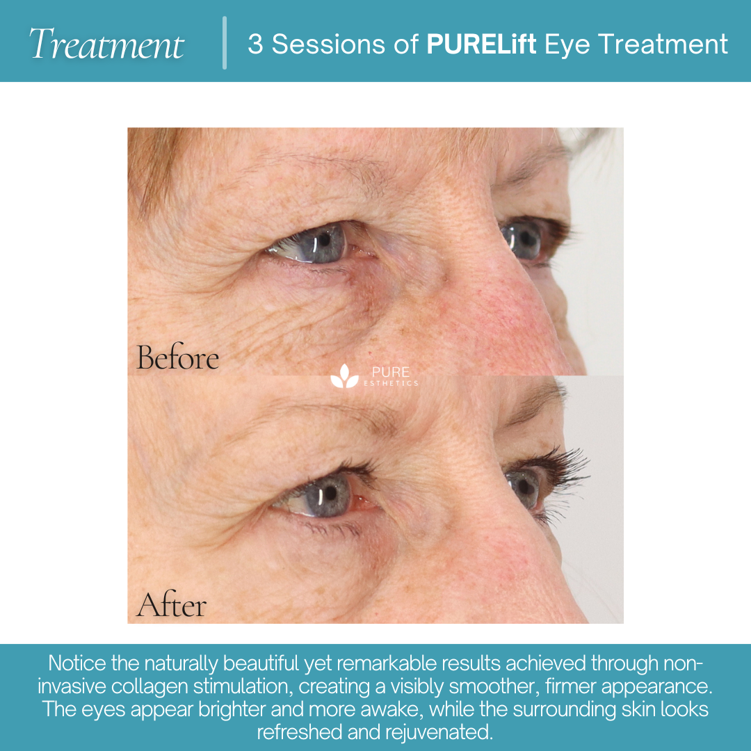 PURELift Eyes Before & After