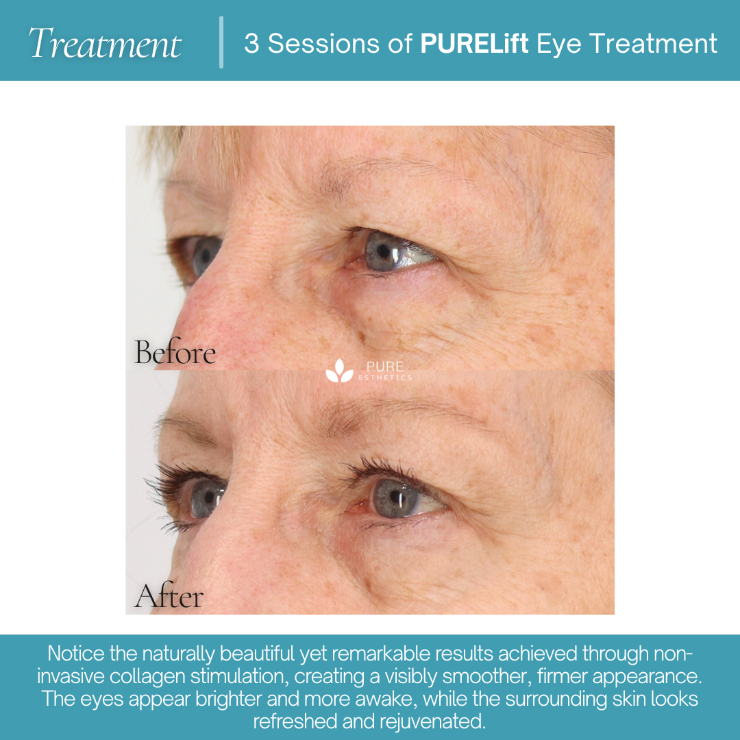 PURELift Eyes Before & After