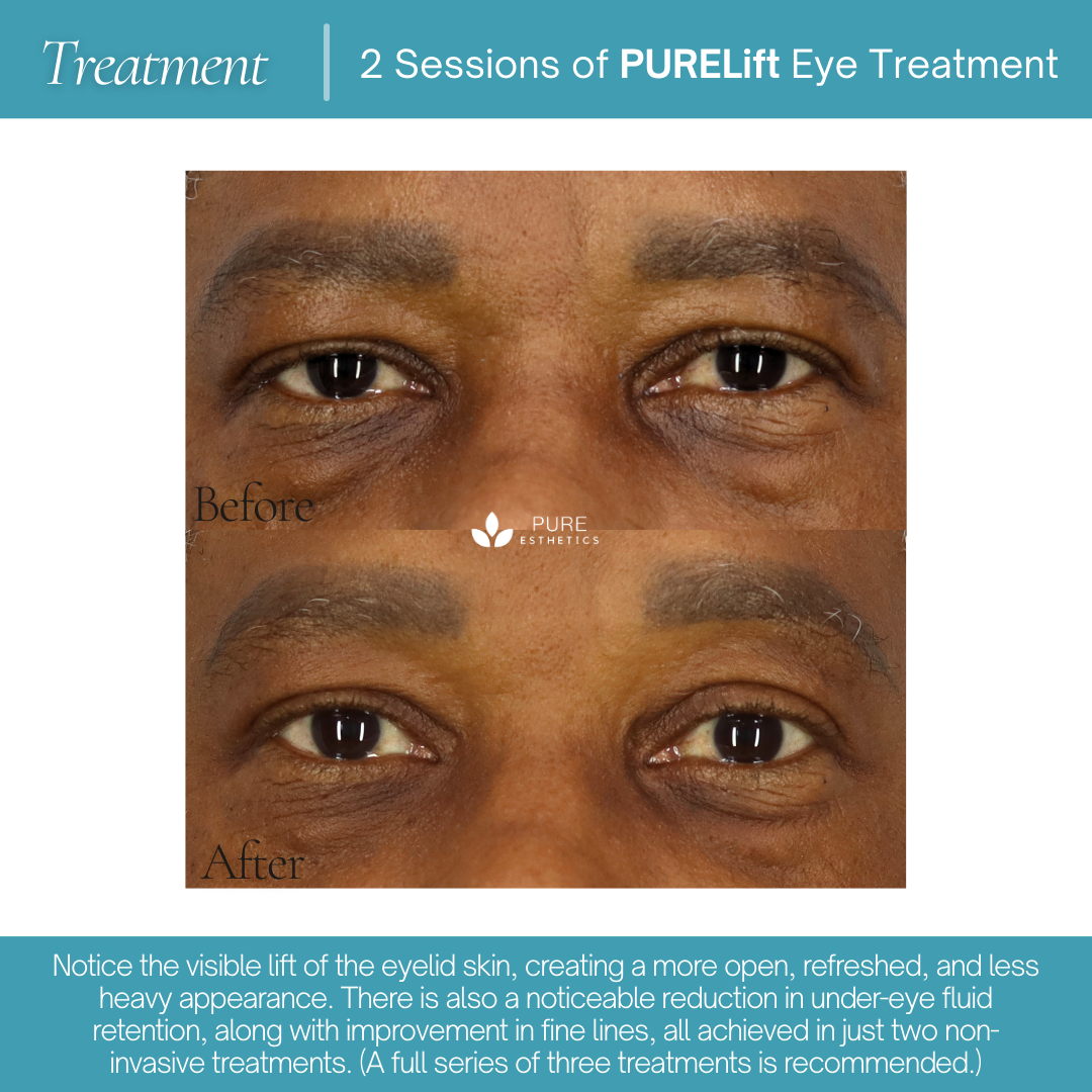 PURELift Eyes Before & After