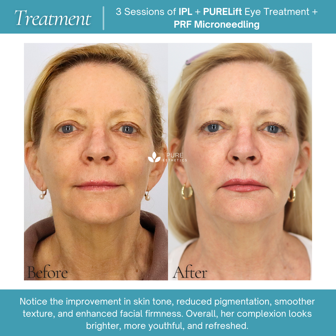 PRF Microneedling Before & After