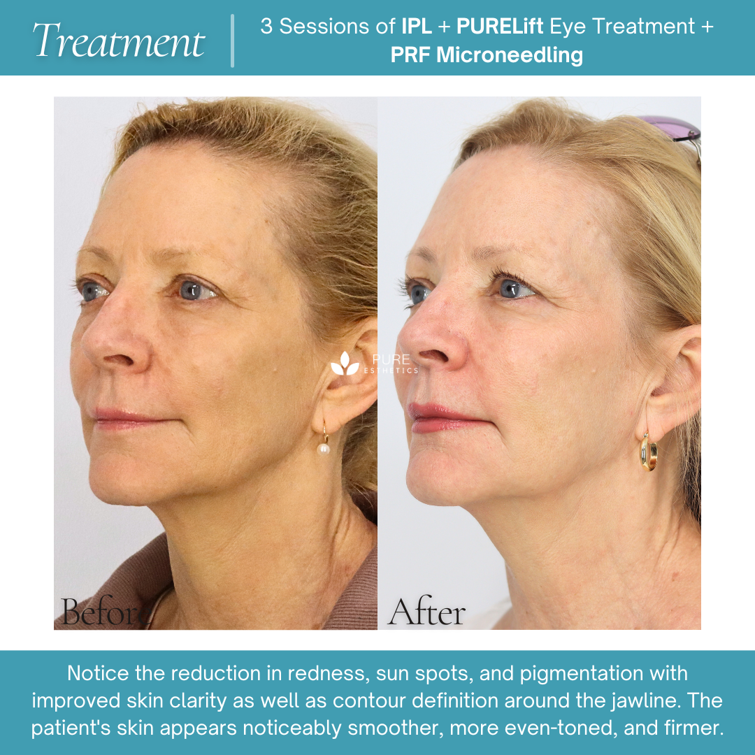 PRF Microneedling Before & After