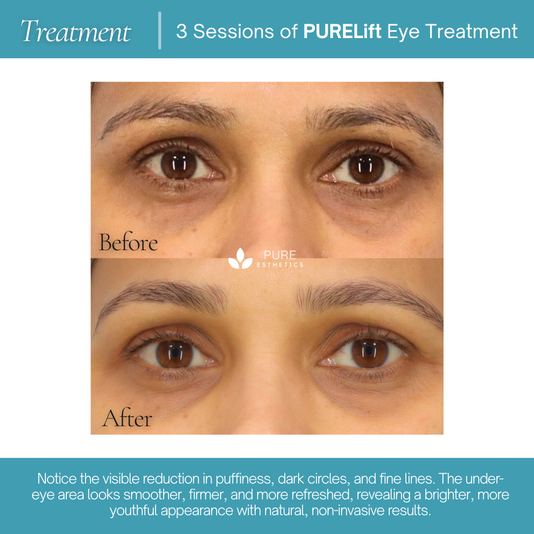 PURELift Eyes Before & After