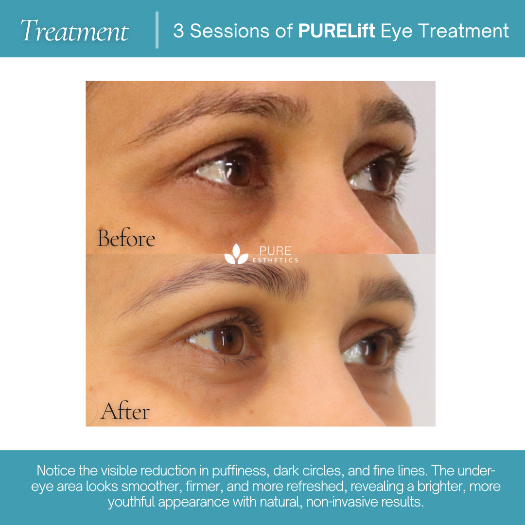 PURELift Eyes Before & After