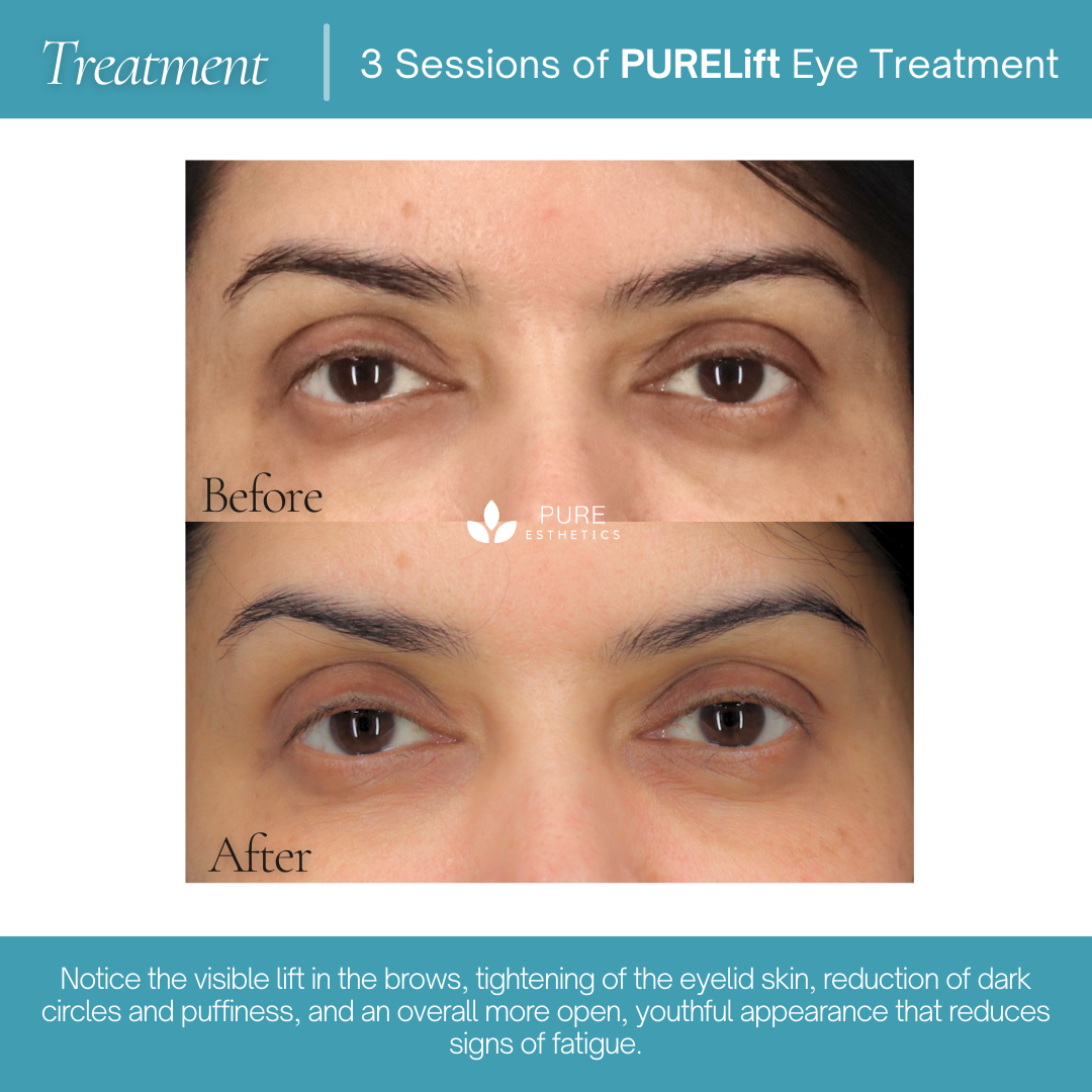 PURELift Eyes Before & After